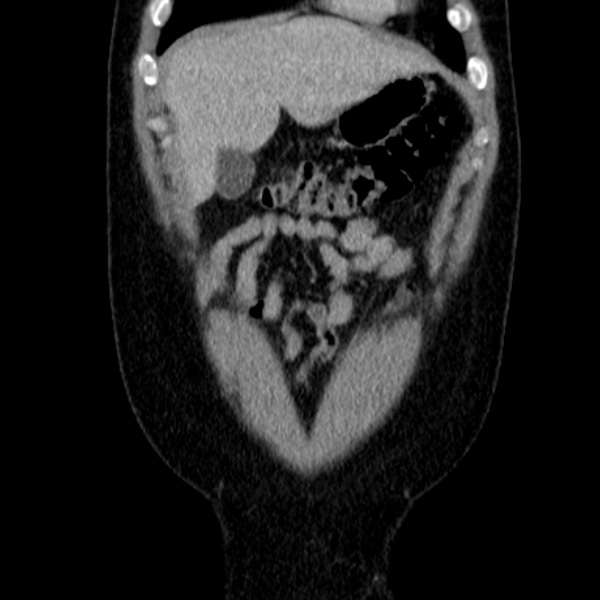 Acute appendicitis (Radiopaedia 38255-40270 Coronal C+ portal venous phase 19).jpg