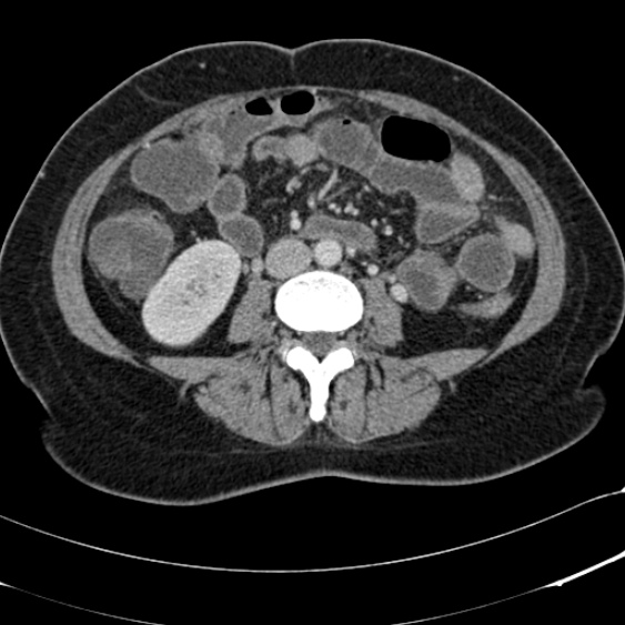 File:Acute appendicitis (Radiopaedia 48792-53822 Axial C+ portal venous phase 62).jpg