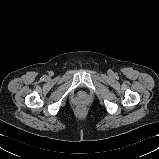 File:Acute appendicitis (Radiopaedia 58627-65818 Axial non-contrast 91).jpg