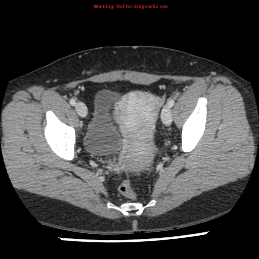 File:Acute appendicitis (Radiopaedia 7966-8812 C+ portal venous phase 48).jpg