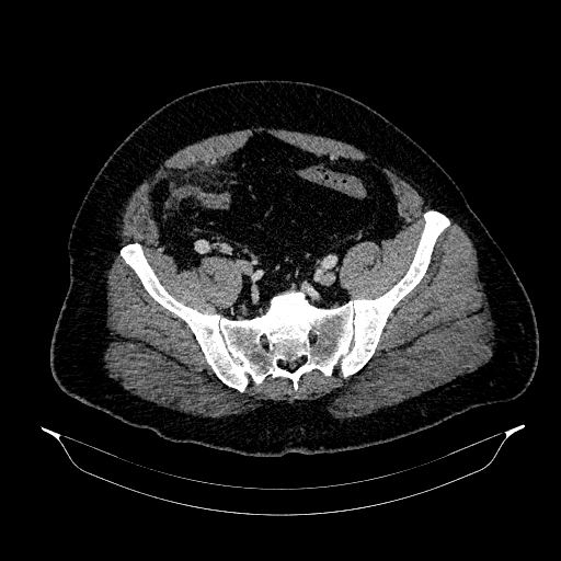 Acute appendicitis (Radiopaedia 79950-93224 Axial C+ portal venous phase 81).jpg