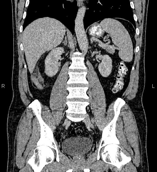 Acute appendicitis (Radiopaedia 84780-100240 Coronal C+ portal venous phase 50).jpg