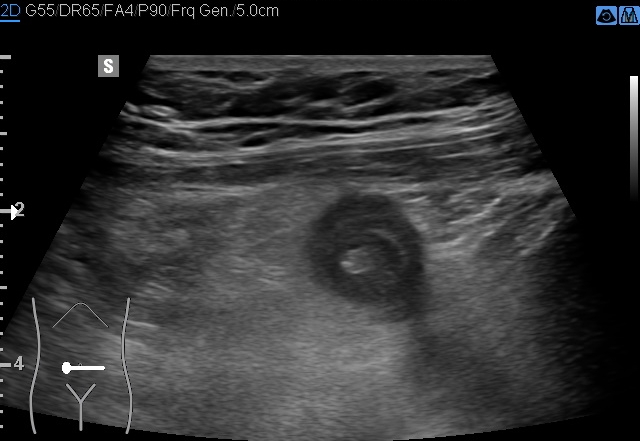 File:Acute appendicitis (Radiopaedia 85193-100745 D 163).jpg
