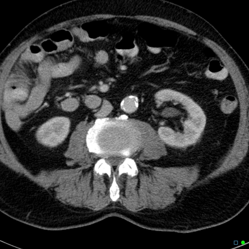 File:Acute appendicitis arising from a malrotated cecum (Radiopaedia 19970-19997 Axial C+ portal venous phase 16).jpg