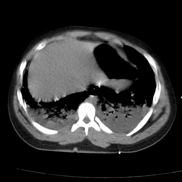 Acute aspiration pneumonitis (Radiopaedia 33605-34703 Axial non-contrast 69).jpg