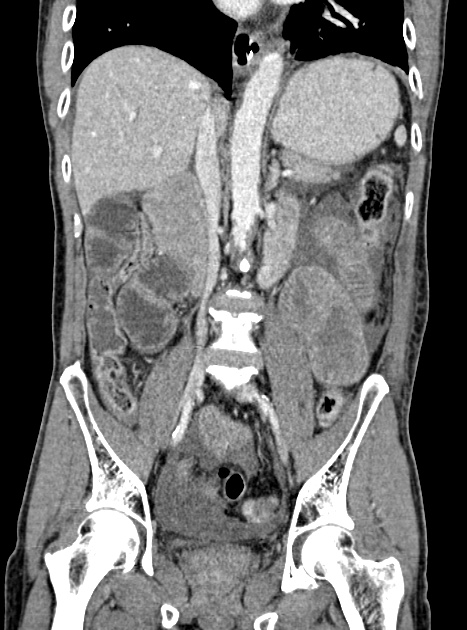 Acute bowel ischemia (Radiopaedia 87695-104114 Coronal C+ portal venous phase 220).jpg