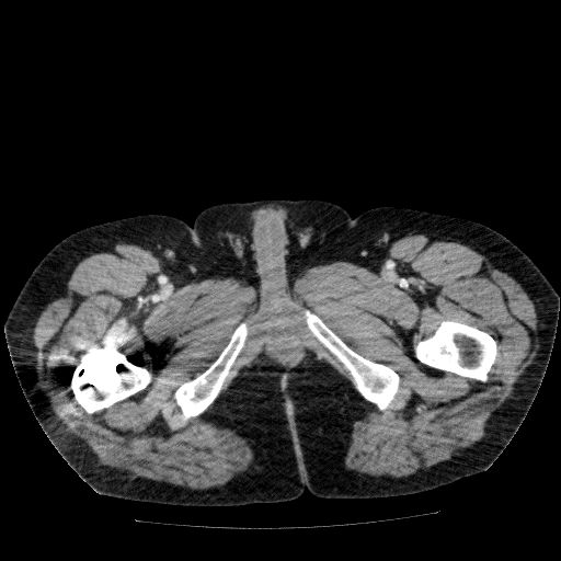 Acute cholecystitis and incidental left sided IVC (Radiopaedia 49352-54459 Axial C+ portal venous phase 170).jpg