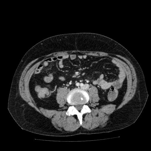 Acute cholecystitis and incidental left sided IVC (Radiopaedia 49352-54459 Axial C+ portal venous phase 92).jpg