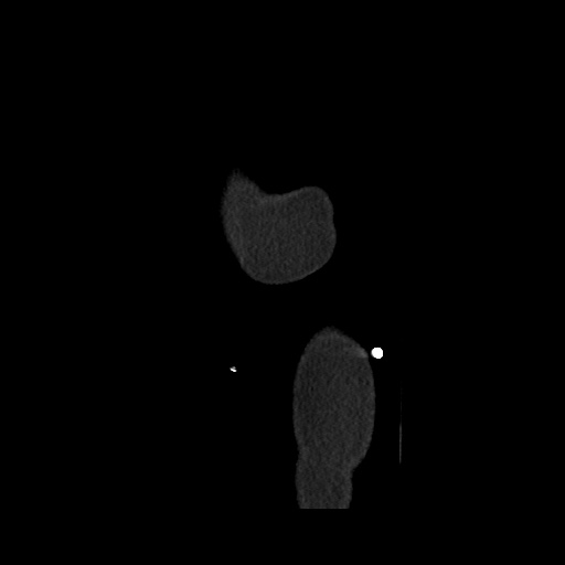File:Acute cholecystitis with tensile fundus sign (Radiopaedia 71394-81723 Sagittal non-contrast 172).jpg