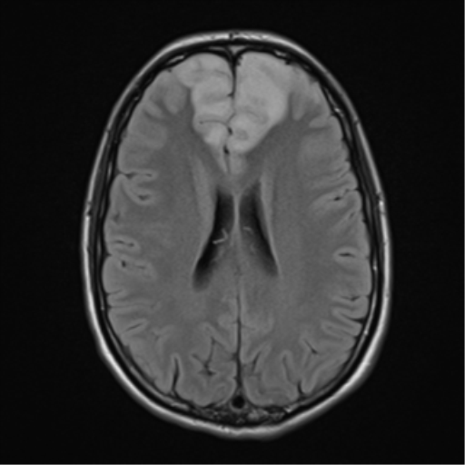 File:Acute disseminated encephalomyelitis (ADEM) (Radiopaedia 65319-74349 Axial FLAIR 20).png