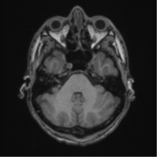 Acute disseminated encephalomyelitis (ADEM) (Radiopaedia 65319-74349 Axial T1 13).png