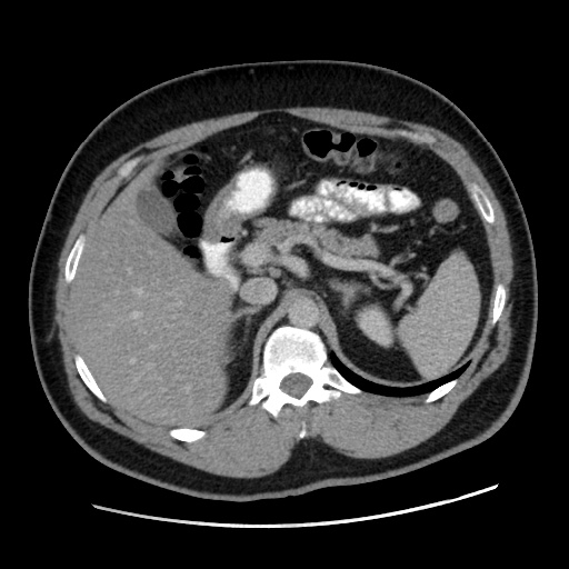 Acute diverticulitis with localized perforation (Radiopaedia 41296-44113 Axial C+ portal venous phase 27).jpg