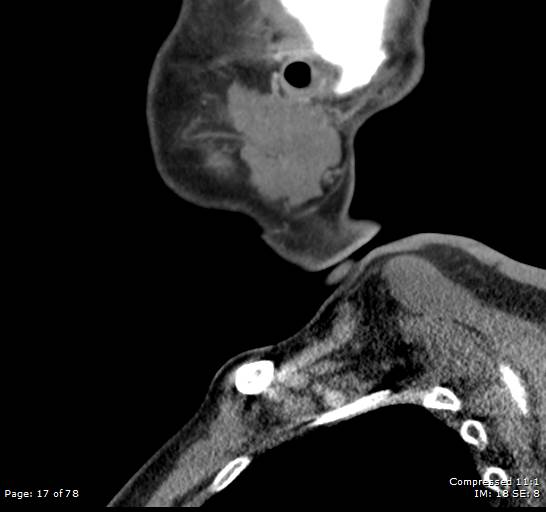 Acute epiglottitis (Radiopaedia 54375-60590 Sagittal C+ arterial phase 17).jpg