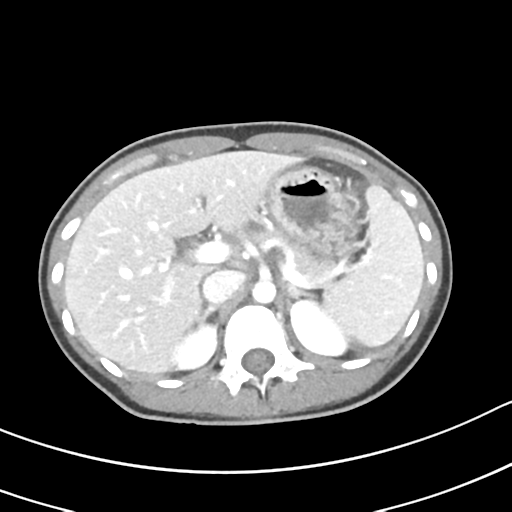 Acute gangrenous appendicitis with perforation (Radiopaedia 40152-42662 Axial C+ portal venous phase 17).png