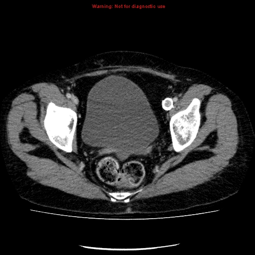 Acute gangrenous cholecystitis (Radiopaedia 10123-10661 Axial C+ portal venous phase 92).jpg