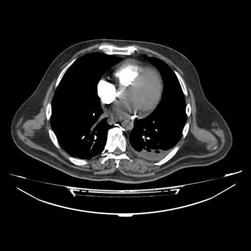 Acute heart failure (CT) (Radiopaedia 79835-93075 Axial C+ arterial phase 28).jpg
