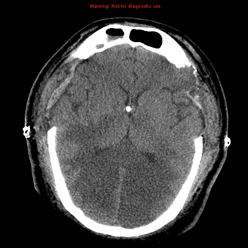 Acute hemorrhagic leukoencephalitis (Radiopaedia 14076-43697 Axial non-contrast 25).jpg
