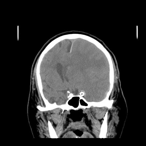 Acute hemorrhagic stroke (Radiopaedia 17507-17223 Coronal non-contrast 21).jpg