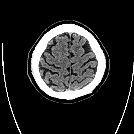 File:Acute left middle cerebral artery territory ischemic stroke (Radiopaedia 35688-37223 Axial non-contrast 73).png