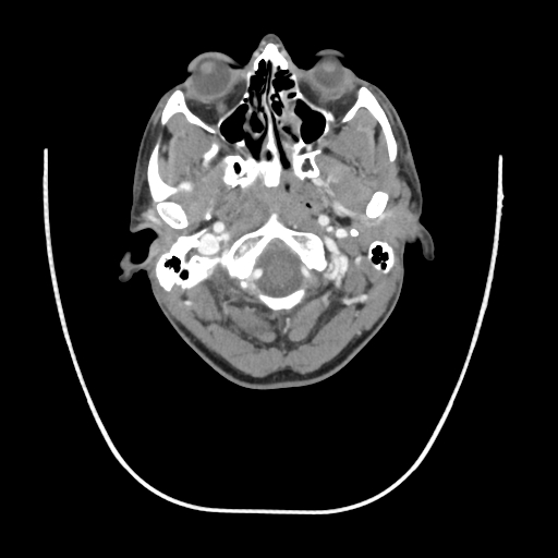 Acute longus colli calcific tendinitis (Radiopaedia 72495-83036 Axial C+ arterial phase 11).jpg