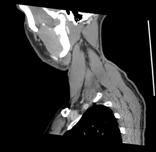 Acute longus colli calcific tendinitis (Radiopaedia 72495-83036 Sagittal C+ arterial phase 9).jpg