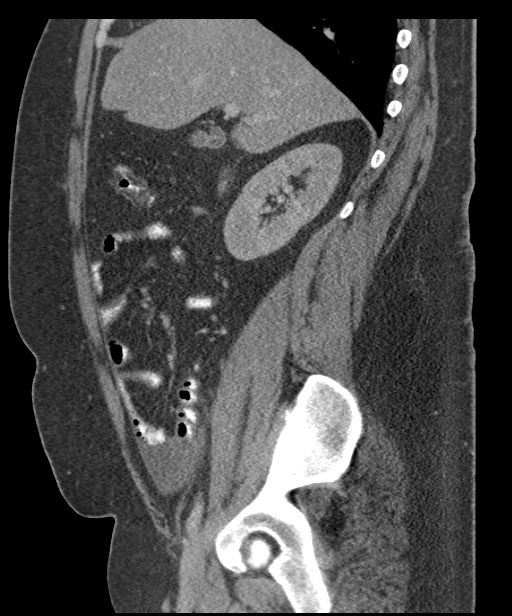Acute mesenteric venous ischemia (Radiopaedia 46041-50383 Sagittal C+ portal venous phase 38).jpg