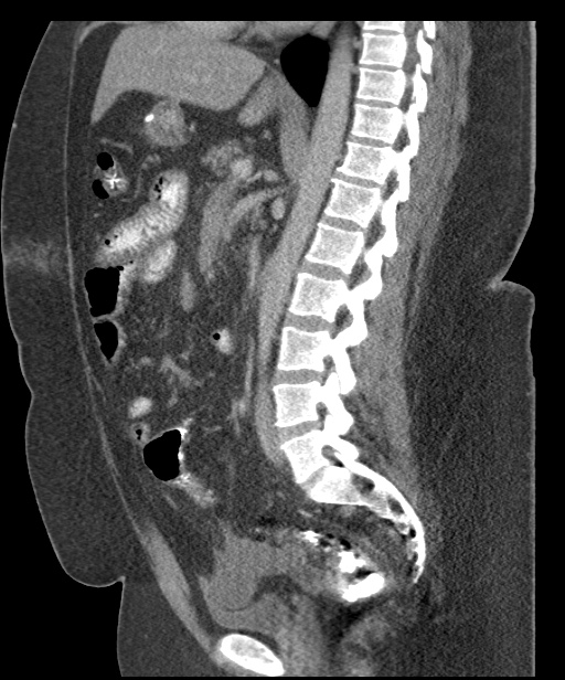 Acute mesenteric venous ischemia (Radiopaedia 46041-50383 Sagittal C+ portal venous phase 62).jpg