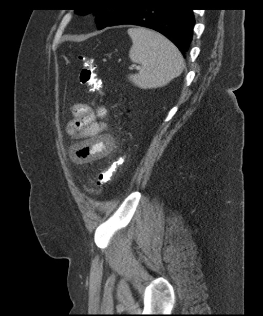 Acute mesenteric venous ischemia (Radiopaedia 46041-50383 Sagittal C+ portal venous phase 97).jpg