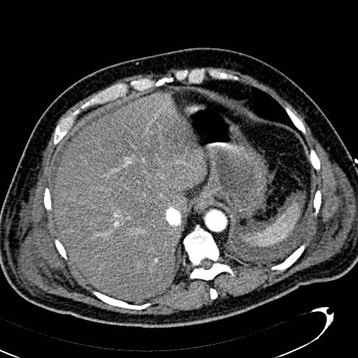 File:Acute pancreatic necrosis (Radiopaedia 13560-13486 Axial C+ portal venous phase 30).jpg