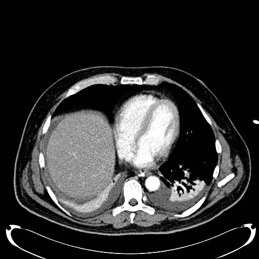 Acute pancreatic necrosis (Radiopaedia 13560-18500 Axial C+ portal venous phase 15).jpg