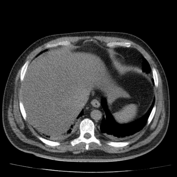 Acute pancreatitis (Radiopaedia 26663-26813 Axial non-contrast 17).jpg