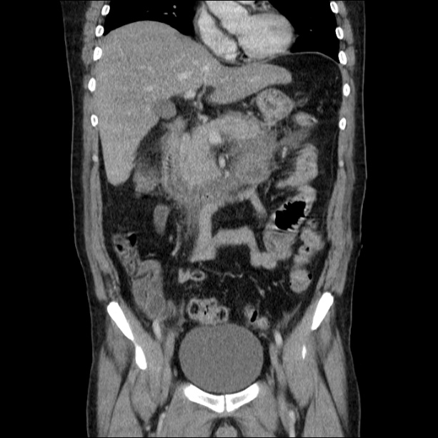 Acute pancreatitis (Radiopaedia 26663-26813 Coronal C+ portal venous phase 29).jpg