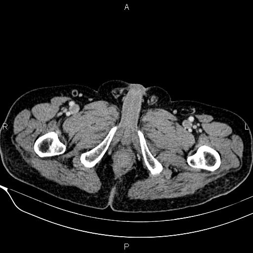 Acute pancreatitis (Radiopaedia 85146-100701 Axial C+ portal venous phase 68).jpg