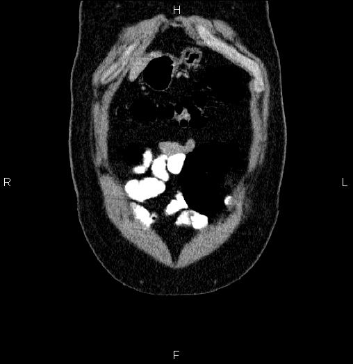 Acute pancreatitis (Radiopaedia 85390-101010 Coronal C+ portal venous phase 1).jpg
