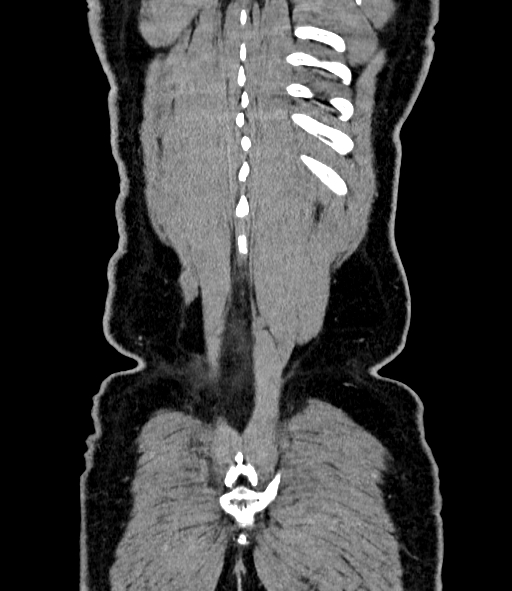 Acute pancreatitis (Radiopaedia 87428-103757 Coronal C+ portal venous phase 86).jpg