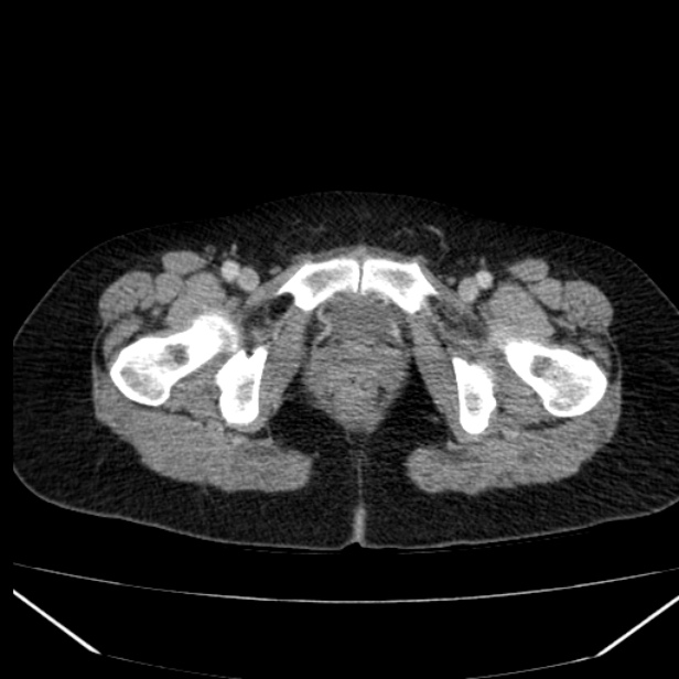 Acute pancreatitis - Balthazar C (Radiopaedia 26569-26714 Axial C+ portal venous phase 95).jpg