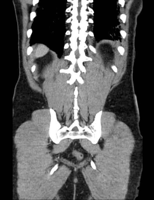 Acute pancreatitis - Balthazar E (Radiopaedia 23080-23110 Coronal C+ portal venous phase 68).jpg