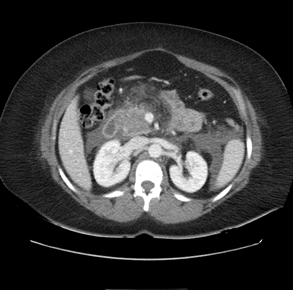 Acute pancreatitis - Balthazar E (Radiopaedia 29016-29377 Axial C+ portal venous phase 26).png