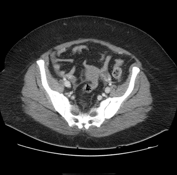 Acute pancreatitis - Balthazar E (Radiopaedia 29016-29377 Axial C+ portal venous phase 59).png