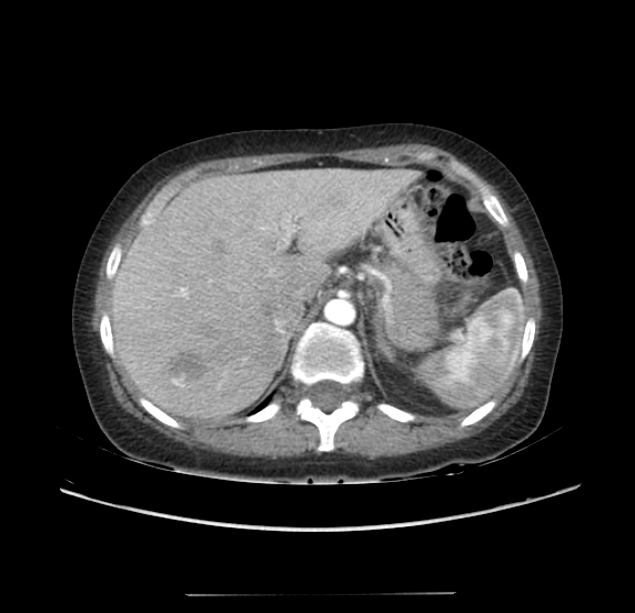 File:Acute pancreatitis - Balthazar E - post ERCP (Radiopaedia 27562-27772 Axial C+ arterial phase 11).png