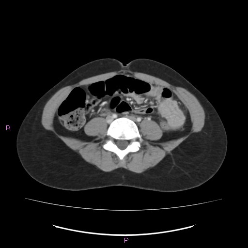 Acute pancreatitis secondary to stone at minor papilla and pancreatic divisum (Radiopaedia 76570-88333 Axial C+ portal venous phase 48).jpg