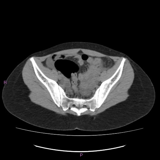 File:Acute pancreatitis secondary to stone at minor papilla and pancreatic divisum (Radiopaedia 76570-88333 Axial non-contrast 62).jpg