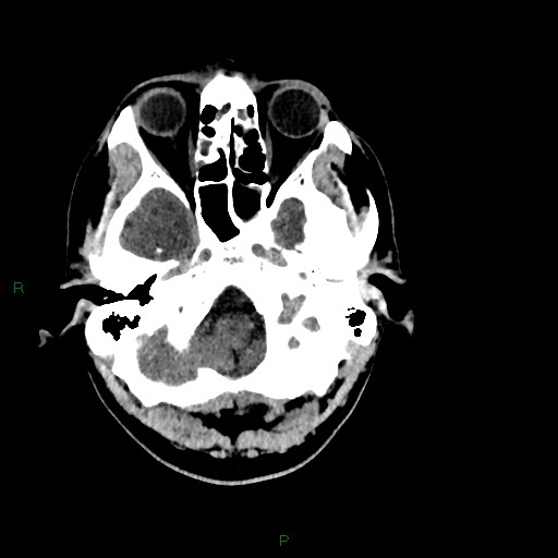 Acute posterior cerebral artery territory infarct (Radiopaedia 79329-92393 Axial non-contrast 17).jpg