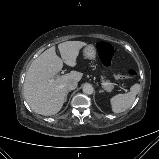 Acute renal artery occlusion (Radiopaedia 86586-102682 Axial C+ portal venous phase 14).jpg