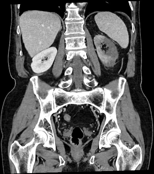 Acute renal infarction (Radiopaedia 59375-66736 Coronal C+ portal venous phase 43).jpg