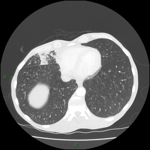 File:Acute right lung abscess (Radiopaedia 34806-36258 Axial lung window 146).jpg