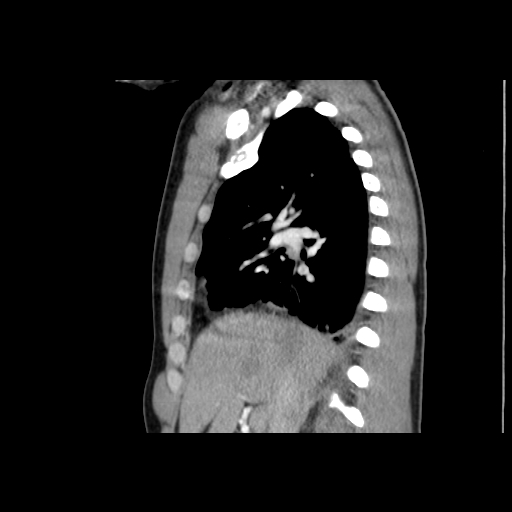 File:Acute segmental pulmonary emboli and pulmonary infarction (Radiopaedia 62264-70444 Sagittal C+ CTPA 25).jpg