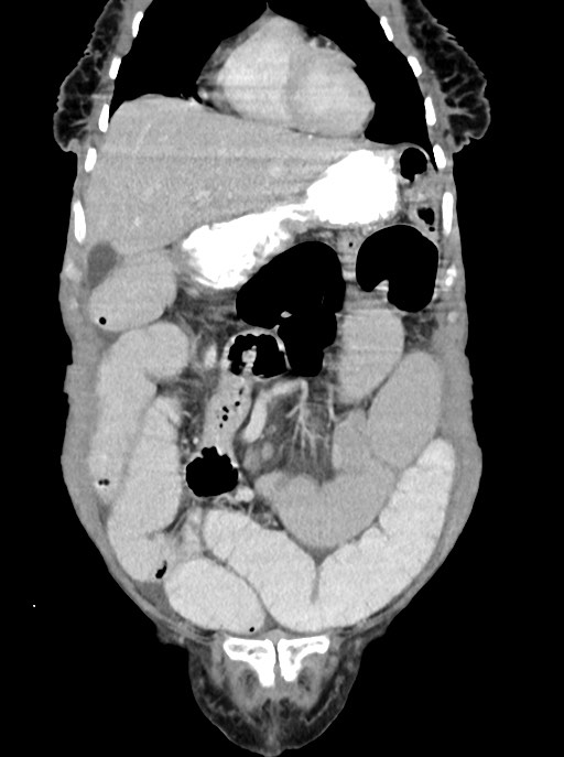 Acute small bowel (ileal) volvulus (Radiopaedia 71740-82139 Coronal C+ portal venous phase 32).jpg