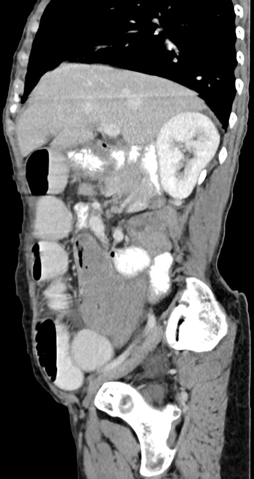 Acute small bowel (ileal) volvulus (Radiopaedia 71740-82139 Sagittal C+ portal venous phase 111).jpg