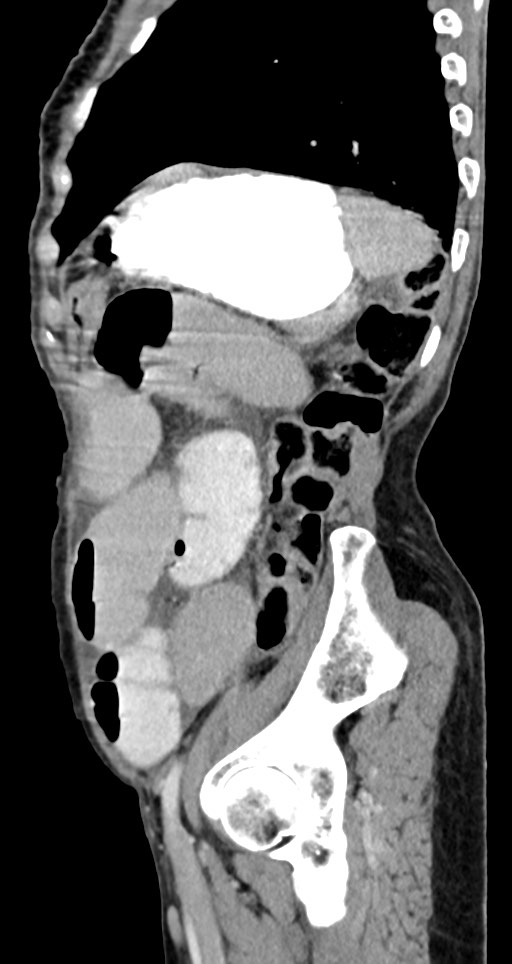Acute small bowel (ileal) volvulus (Radiopaedia 71740-82139 Sagittal C+ portal venous phase 51).jpg
